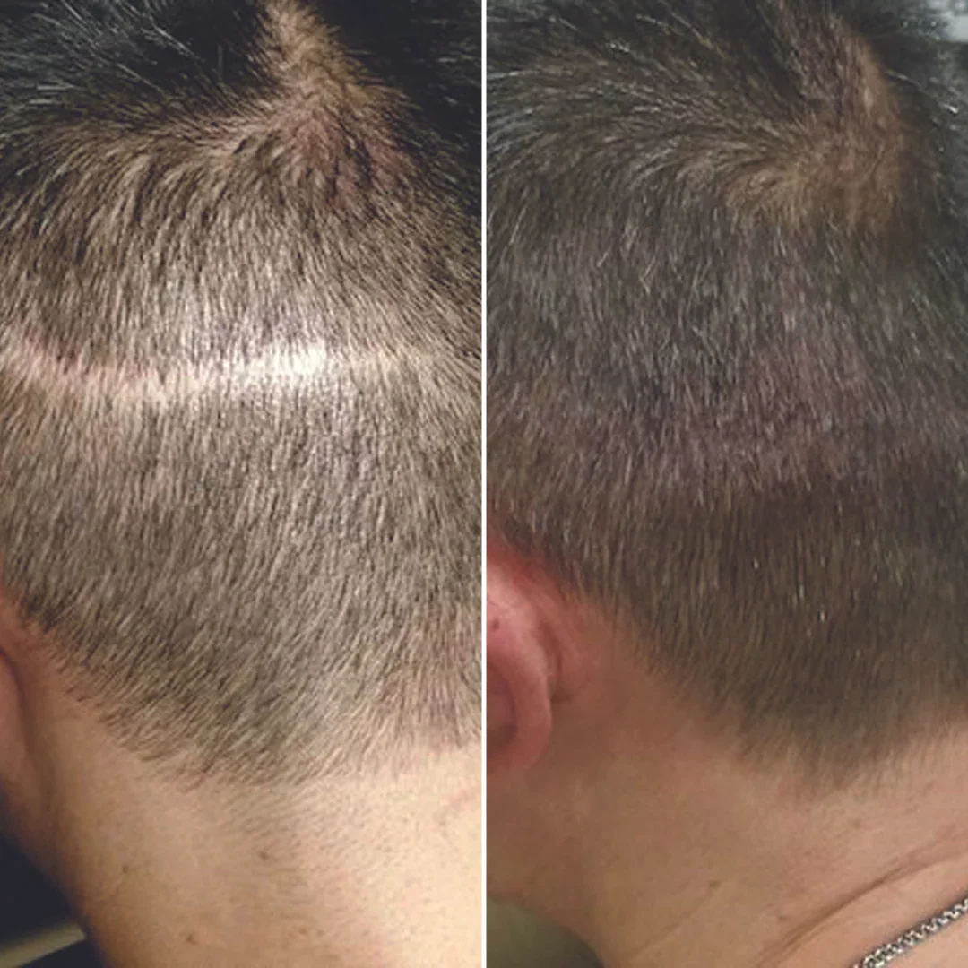 Antes e depois de camuflagem capilar, exemplo 1