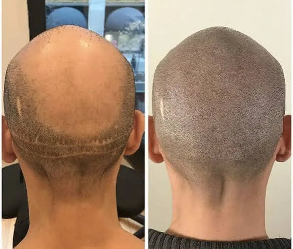 Antes e depois de camuflagem capilar, exemplo 2