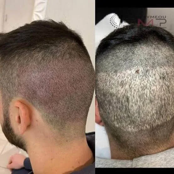 Antes e depois de camuflagem capilar, exemplo 3