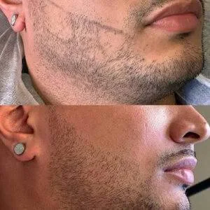 Antes e depois de camuflagem de barba, exemplo 1