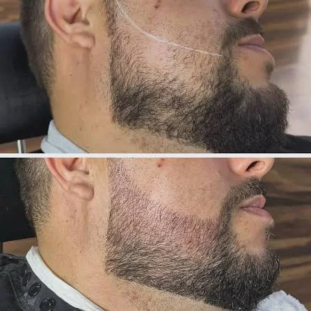 Antes e depois de camuflagem de barba, exemplo 3