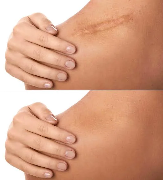 Antes e depois de camuflagem de cicatriz, exemplo 2