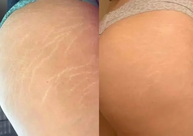 Antes e depois de camuflagem de estrias, exemplo 1