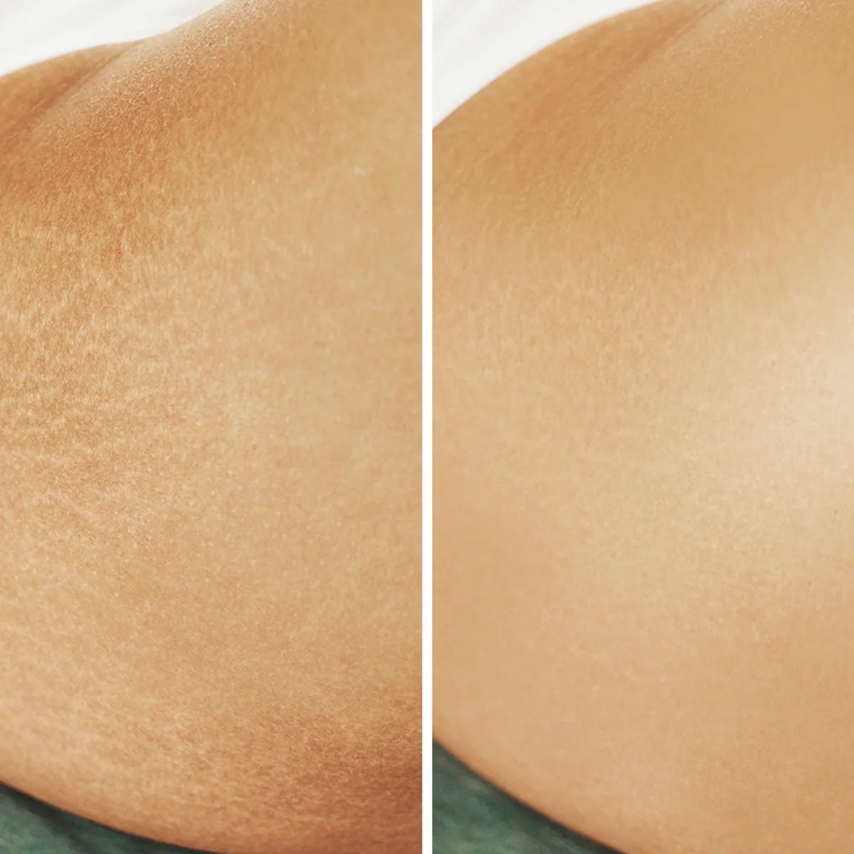 Antes e depois de camuflagem de estrias, exemplo 2