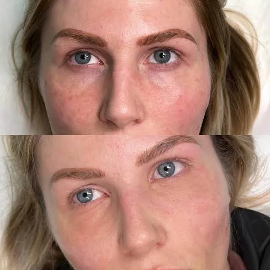 Antes e depois de camuflagem de olheiras, exemplo 1