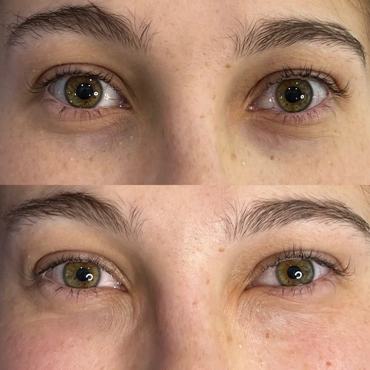 Antes e depois de camuflagem de olheiras, exemplo 3