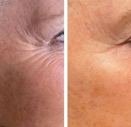 Antes e depois de jato de plasma, exemplo 2